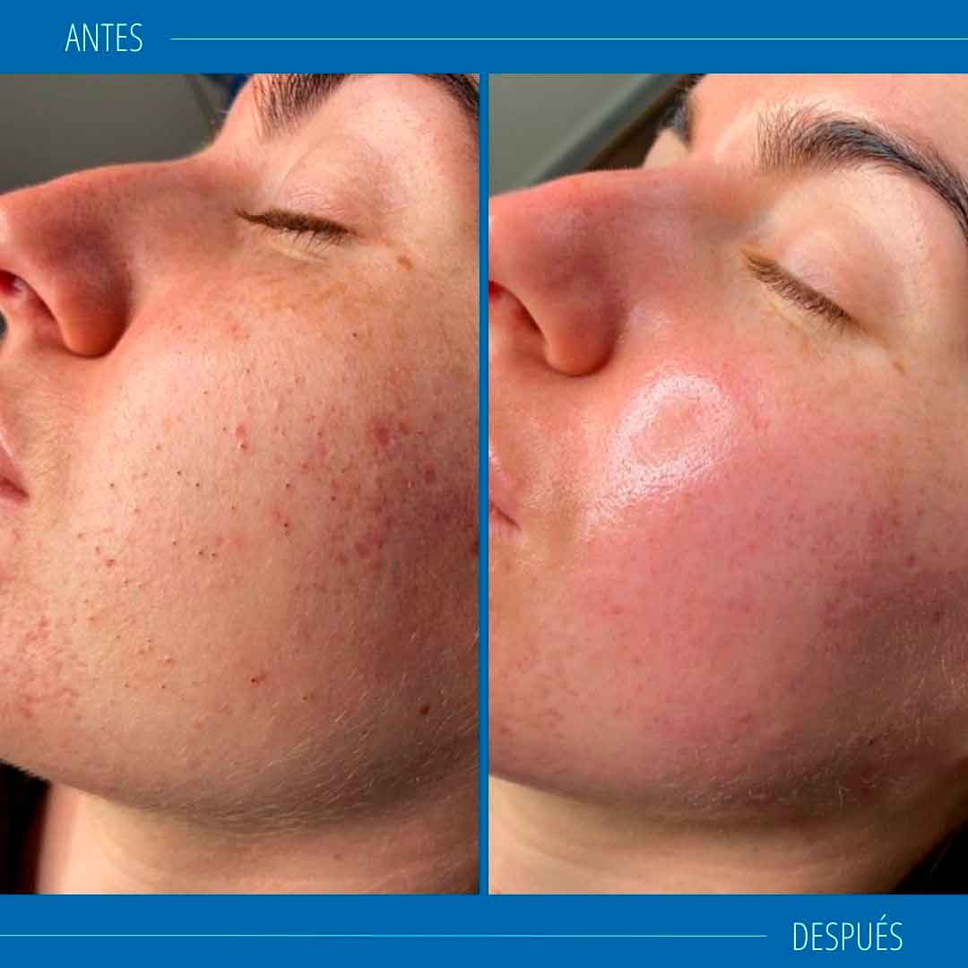 Hydrafacial Tratamiento